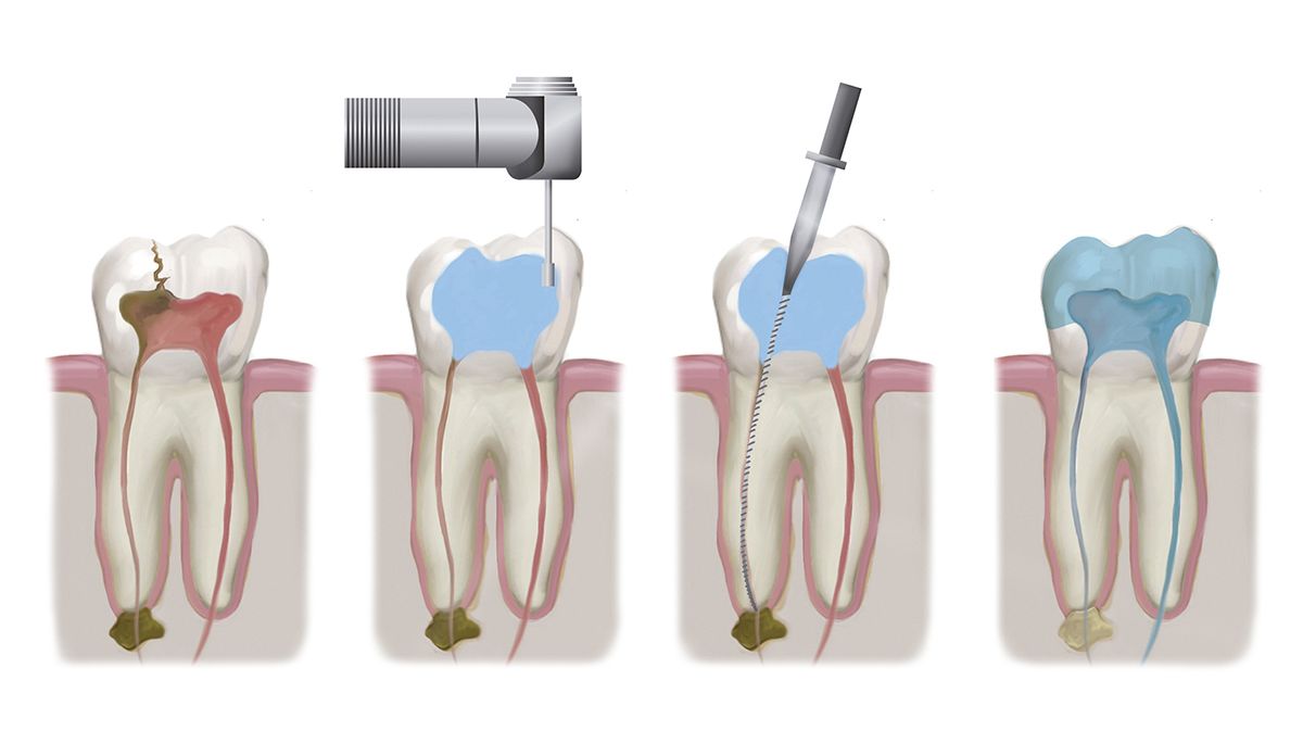 Illustration depicting steps of root canal treatment