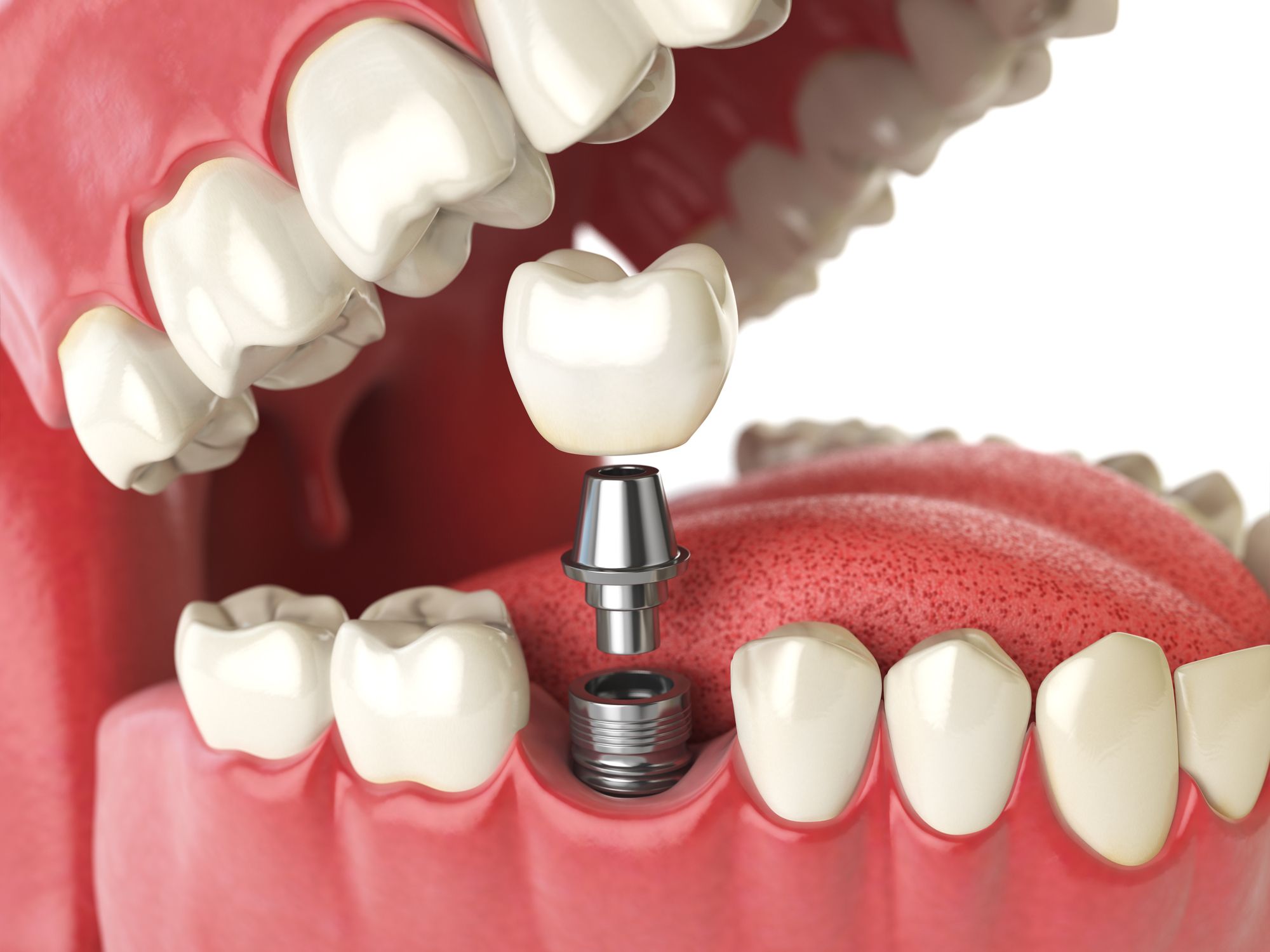 Model of jaw and implant-supported crown