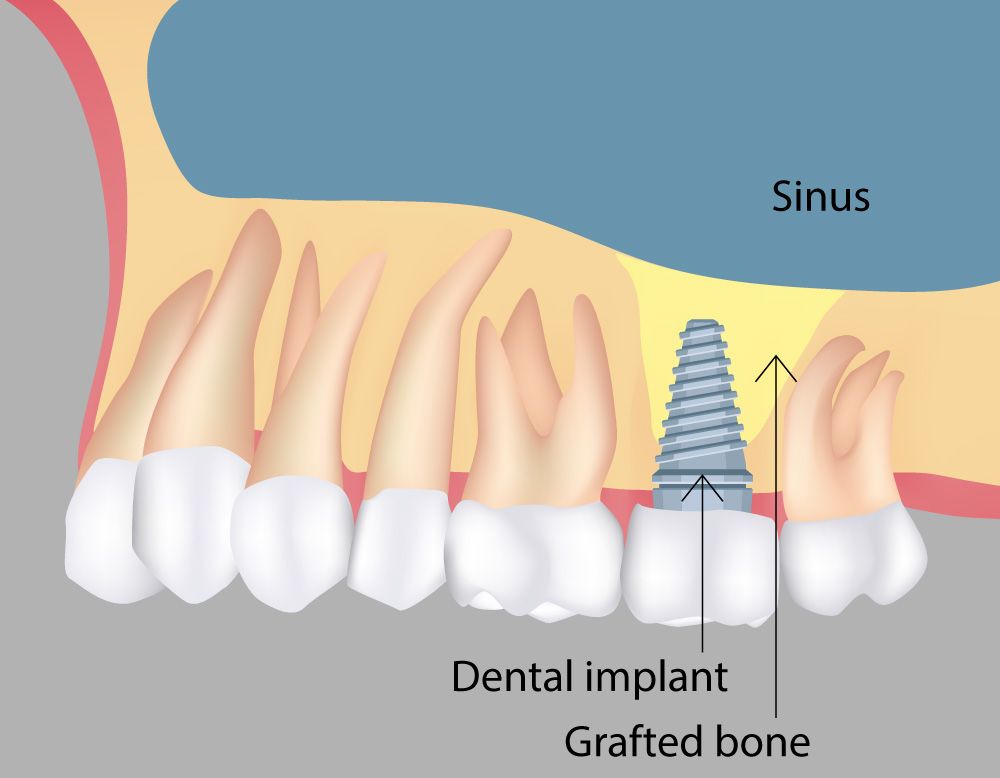 image of bone graft